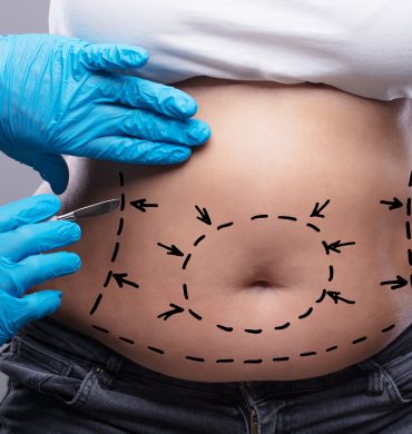 Liposukcja strzykawkowa - profesjonalne zabiegi medycyny estetycznej w The Beauty Doctors Olsztyn w Olsztynie