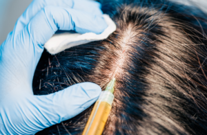 leczenie zapalenia mieszków włosówych
