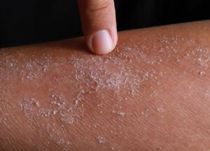 Dlaczego powstaje atopowe zapalenie skóry?